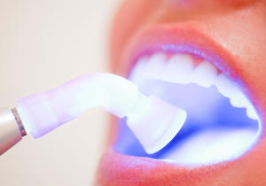 Composite bonding how our dentist uses UV cured resins